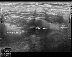 Tip Appendicitis Radiology Case Radiopaedia Org Radiopaedia is free thanks to our supporters and advertisers.become a. tip appendicitis radiology case