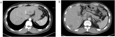 Radiotherapy is the single modality. Elimination Liver Metastasis Of Nasopharyngeal Carcinoma Might Improve Overall Survival Sciencedirect