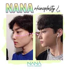Men Rhinoplasty Before And After Rhinoplasty Plastic Surgery Rhinoplasty Before And After