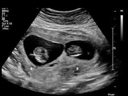 Gemelos O Mellizos Club De Bebes Agosto 2020 Babycenter