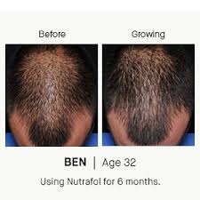 So how much will hair grow in 6 months? Amazon Com Nutrafol Mens Hair Growth Supplement For Thicker Stronger Hair 4 Capsules Per Day 1 Month Supply Health Personal Care