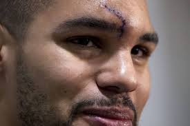 Leafs defenceman Fraser thankful head injury wasn't more serious