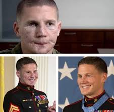 Medal Of Honor recipient Kyle Carpenter before and after facial  reconstruction surgery. Medal Of Honor recipient Kyle Carpenter before and  after facial reconstruction surgery. William Kyle Carpenter is a medically  retired United