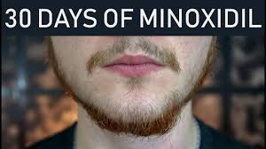 How to apply liquid minoxidil for beard. Minoxidil Is Dangerous 30 Days Of Minoxidil Beard Growth Minoxidil Beard Transformation Youtube