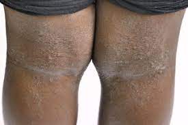 Atopic Eczema Symptoms Nhs