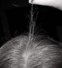 Hair loss (alopecia) can affect just your scalp or your entire body, and it can be temporary or permanent. My Hair Is Very Thin From Hair Breakage Can You Help
