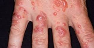 Image result for dermatitis contacta allergica
