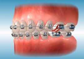Soft foods are highly recommended after the first few days of getting your braces. Orthodontic Appliances Braces Invisalign Wilmington Orthodontics