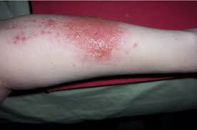 Psoriasis, in addition to a rash on the skin, often displays changes on the fingernails or toenails of the affected hands and/or feet and is associated with sharp, round borders, while irritant or allergic. What S My Rash Pictures And Descriptions Of 21 Rash Types Plushcare