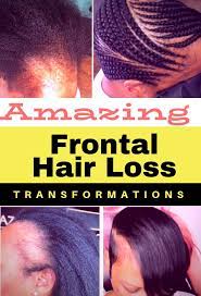 Hair Loss Transformations Frontal Hair Loss Hair Loss Hair Loss Alopecia