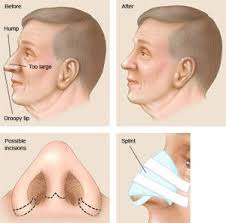 Individuals With A Breathing Problem Due To A Deviated Septum Septoplasty Is Performed And Can Be Combined With Rhi Rhinoplasty Nose Reshaping Plastic Surgery