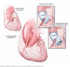 Marfan Syndrome Sparrow