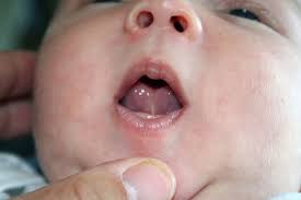 Signs to look out for include difficulty breastfeeding, problems with speech, and pain in the tongue. Tongue Tie And Breastfeeding Breastfeeding Support