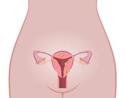 What's the best birth control for women with pcos? Natural Ways To Shrink Fibroids Downriver Obgyn Trenton Michigan