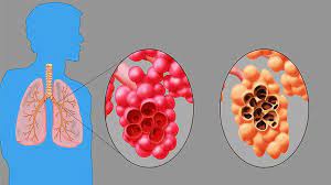However, in emphysema there is the loss of elasticity of the alveolar sacs. Emphysema And Copd Everyday Health