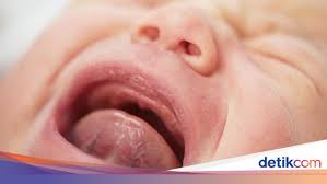 Bayi menyusu badan satu ke dua minit dan mulai timbul rasa tidak selesa pada ibu. Infografis 4 Tipe Tongue Tie Pada Bayi