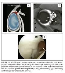 Image result for SLAP Lesion