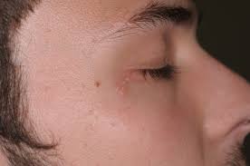 Hsv2, however, unlike hsv1, rarely causes other complications or spreads to different areas of the body outside of its original vicinity. Herpes Simplex Virus Type 1 Hsv1 Fever Blisters Cold Sores Herpes Simplex Virus Type 2 Hsv2 Genital Herpes Herpes Dermatology Advisor