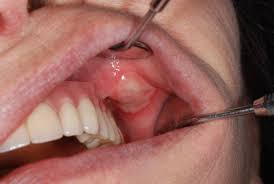 This herpes virus is not the same as the one cau Everything You Need To Know About Gingivostomatitis Cabinet Stomatologic Valcea