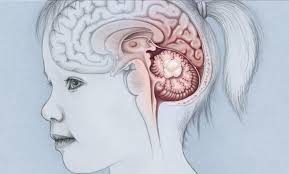 Seizures don't always come from. Origin Of Childhood Brain Tumors Discovered