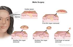 Pink bump with raised edges and a depression in the center; Childhood Basal Cell Carcinoma And Squamous Cell Carcinoma Of The Skin Treatment Pdq Patient Version National Cancer Institute