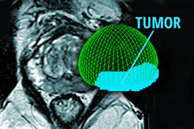 Prostate cancer is a cancer known to be driven by inflammation. Study Finds Marker Of Aggressive Prostate Cancer Washington University School Of Medicine In St Louis