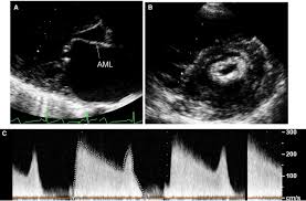 Image result for XRay Changes in Rheumatic Conditions
