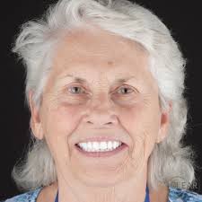 Meet our globetrotter 🌎 patient with a passion for adventure and a dream  of a brighter, whiter smile to match. Seeking to upgrade her current look,  she entrusted us with her smile