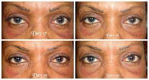 Pin On Blepharoplasty Eyelid Surgery