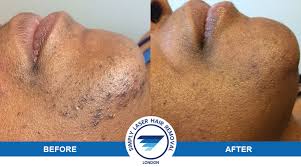 For more details on our products and services, please feel free to visit us at laser hair removal london, full face laser london, best hair removal for women london, nd. Laser Hair Removal For Dark Asian Skin