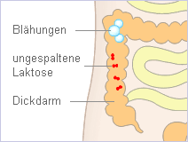 Laktoseintoleranz Die Auswirkungen Und Symptome