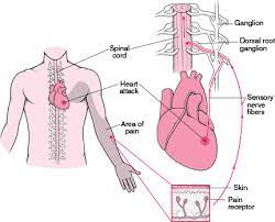 Figure What Is Referred Pain Msd Manual Consumer Version