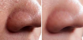 Kali ni bieena nak share tips untuk hilangkan blackhead pula. Buang Whiteheads Guna Vaseline Santai Sini
