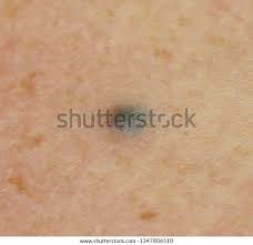 Image result for Blue Nevus