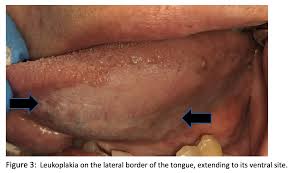 Image result for white cancer on tongue)