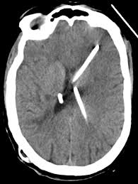 Ct Scan Obtained 3 Years After Vu Shunt Placement The Left Lateral Download Scientific Diagram