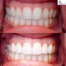 Cosmetic dentistry near me in fresno, ca. Are Porcelain Veneers Right For Me