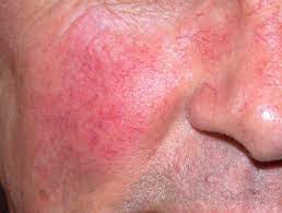 Alcohol and the Skin — DermNet