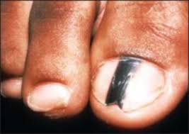 3 it is most commonly diagnosed in the thumbs and big toes. What Does Nail Melanoma Look Like How Skin Cancer Can Hide On Your Finger And Toe Nails 7news