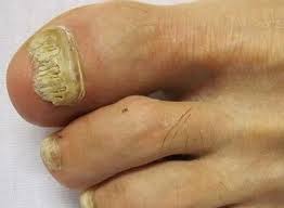 In this post i explain how nail mold vs fungus, how for a very long time pseudomonas was mistaken for nail mold,. Thick Toenails Diagnosis Treatment Foot Pain Explored