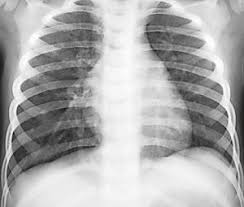Ist Die Pneumonie Fur Sie Ein Kinderspiel Medical Tribune