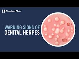 Image result for genital herpes