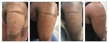 Image result for Postinflammatory Hypopigmentation