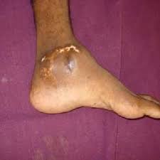 Bone tumors are more often caused by cancer that has spread to the bone from some other part of the body. Clinical Photo Of The Left Ankle Download Scientific Diagram