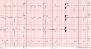 Cardiac arrest see sudden cardiac arrest (sca). Cardiac Arrest Due To Massive Pulmonary Embolism Percutaneous Thrombectomy And Thrombolysis Cardiology