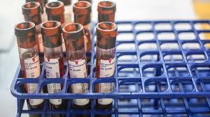 The ca125 test is a blood test used around the world, including in the uk, to help identify ovarian cancer in women who are already presenting with symptoms. The Ca125 Blood Test For Ovarian Cancer Has Been Re Evaluated Cancer Research Uk Cancer News