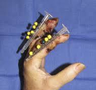 The Syringe External Fixator: Short- and Medium-Term ...