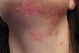 Also liver and digestive problems, cant tolerate milk or dairy. Treat Skin Rash With Homeopath Natural Treatment For Skin Rash