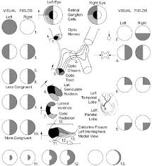 Image result for Visual Field Deficit