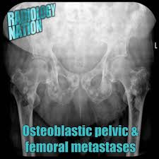 The spread may be very rapid, as in this case, where it took only eight months since … Radiology Nation Here S The Answer To Our Last Case There Is No Fracture But There Are Multiple Scleroticlc Bone Metastases Prostate Cancer Is A Known Common Cause Of Sclerotic Bone Metastases